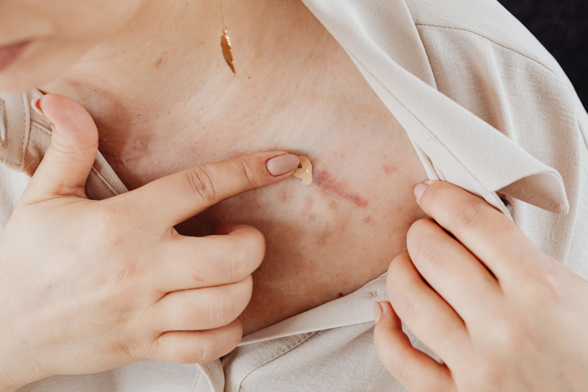 Choosing Your Moments: Patch Testing When Skin Is Already Reactive